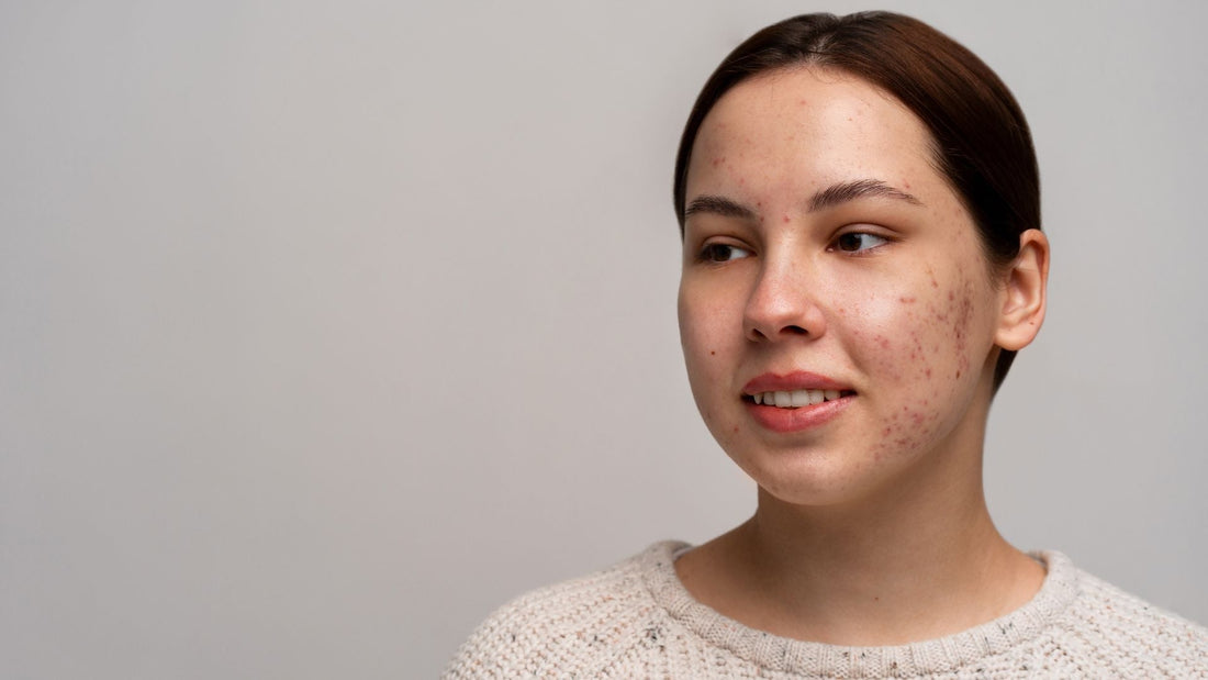 Best Skincare Routine For Acne-Prone Skin